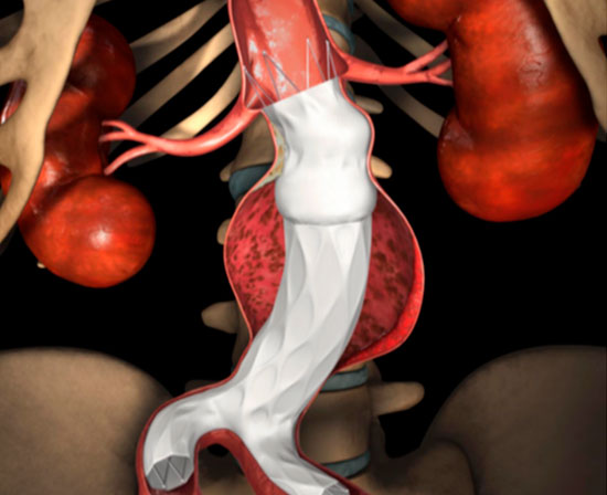 Hipertensión Arterial Vásculo Renal